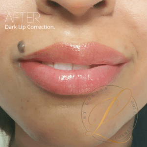 Fiona Dark Lip Correction_after