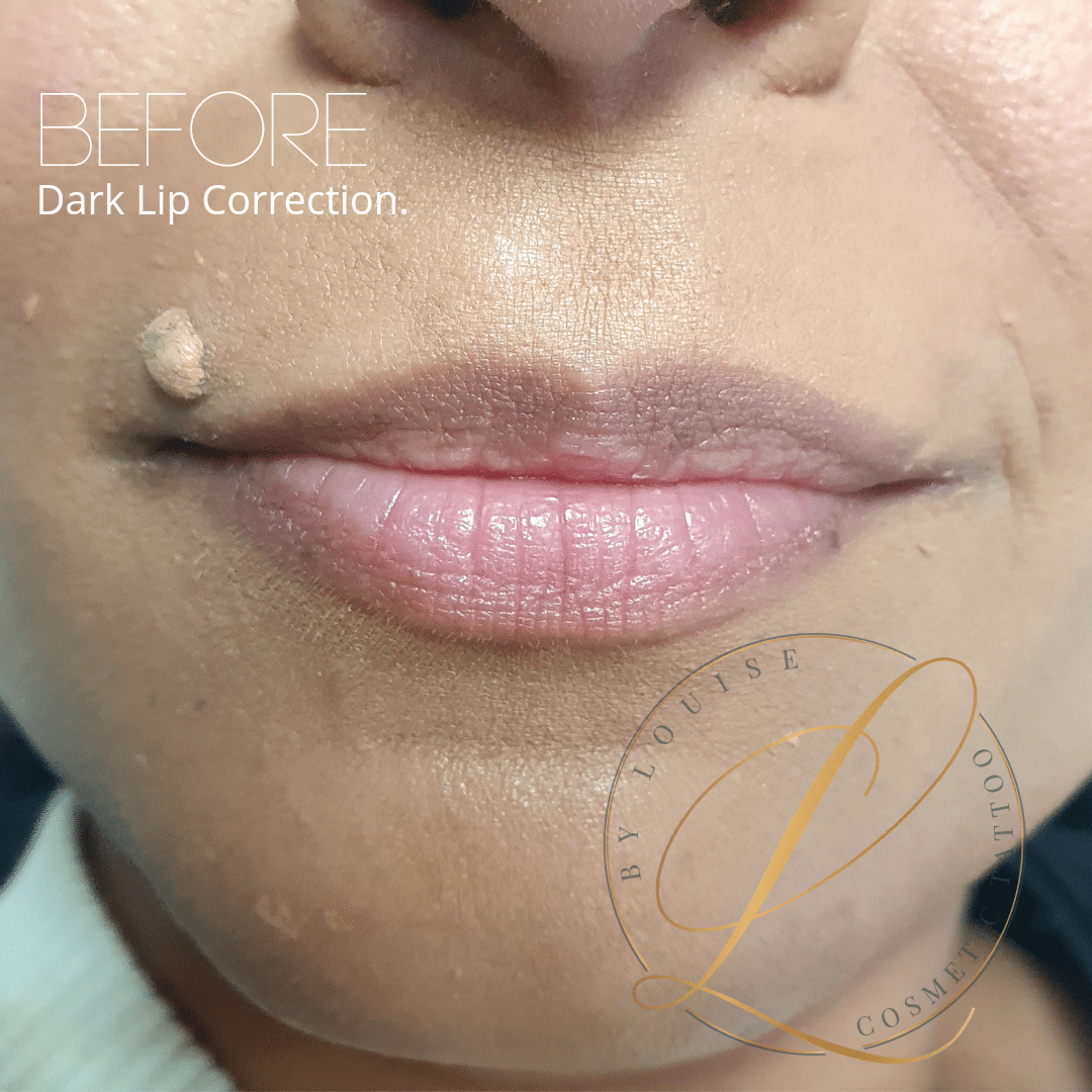 Dark lip correction melbourne