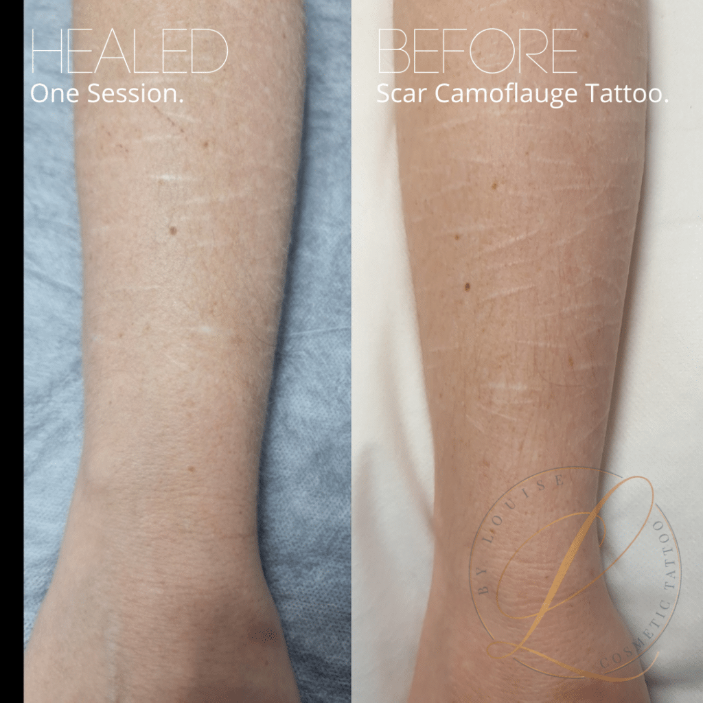 Non Laser Tattoo Removal by Pro Cosmetic Tattoo in Brisbane