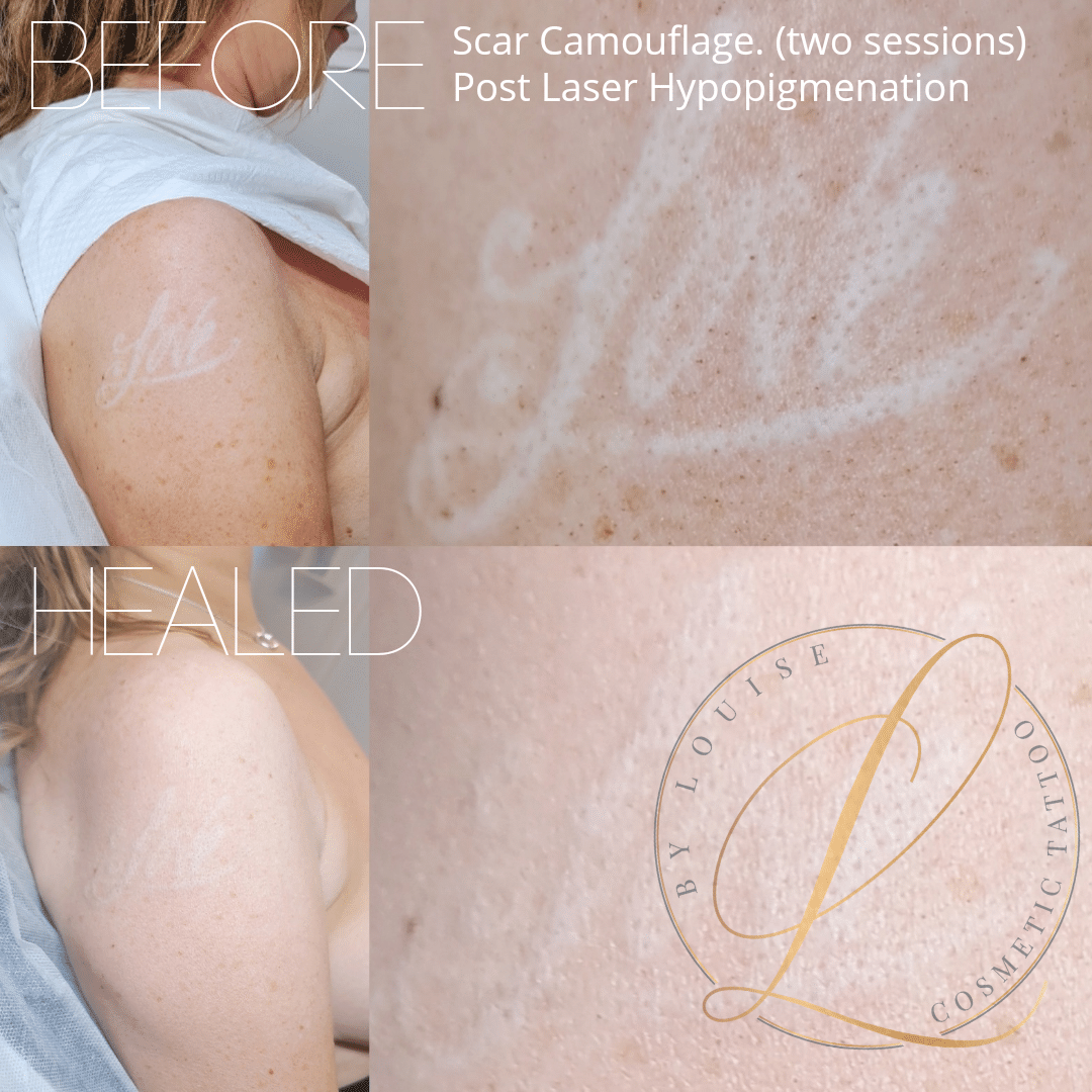 Scars Camouflage  Camouflage Pigmentation  Beauty Bar by Terri  Medical   Cosmetic Tattoo Services in Plano