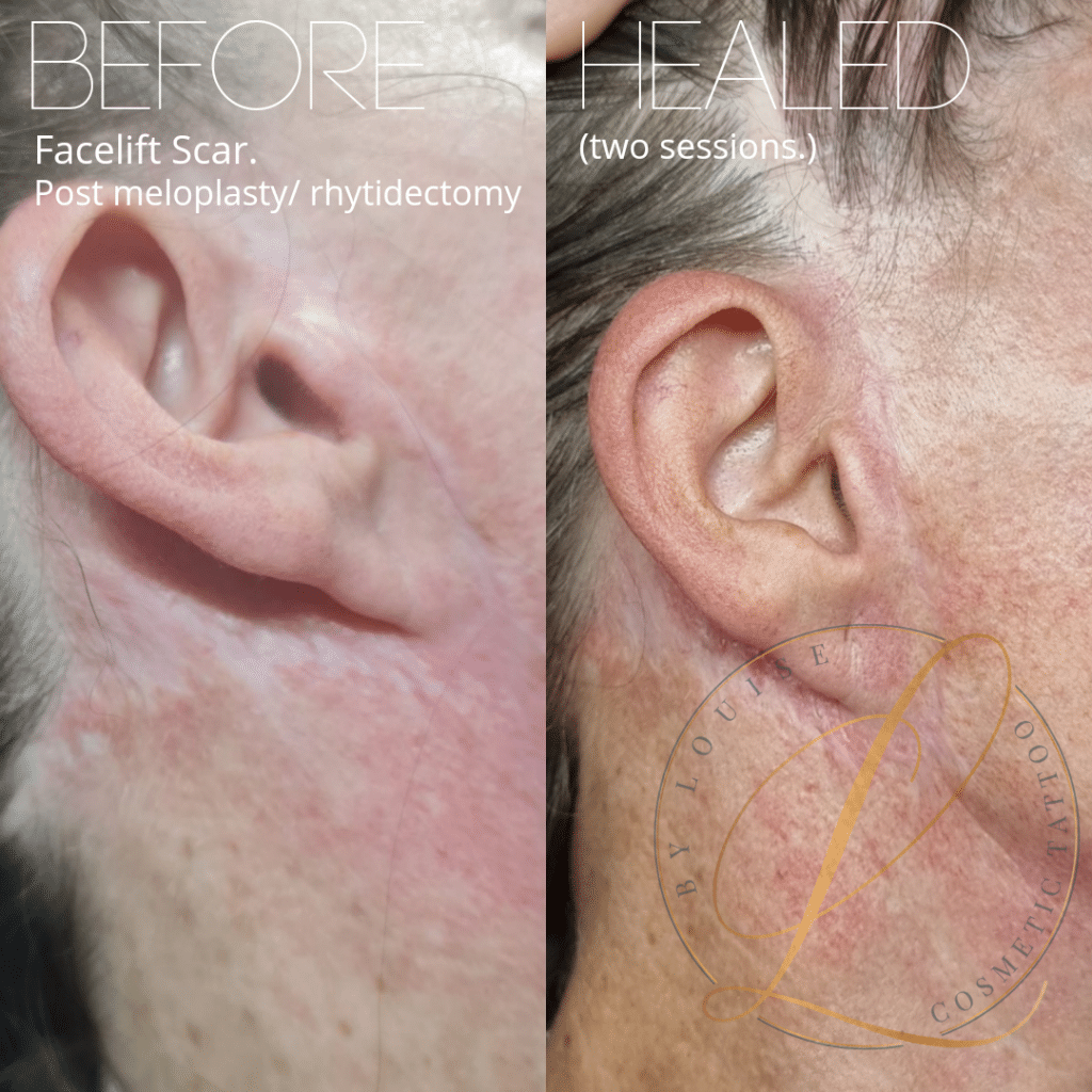 Figure 5 from Dermatography (Medical Tattooing) for Scars and Skin Grafts  in Head and Neck Patients to Improve Appearance and Quality of Life |  Semantic Scholar