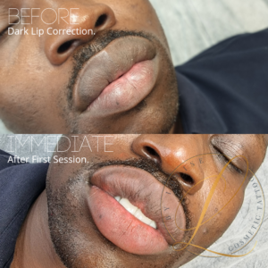 dark lip correction