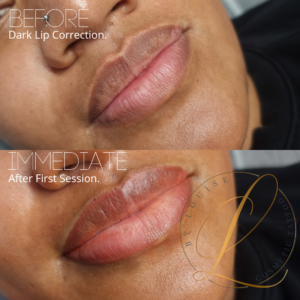 dark lip correction