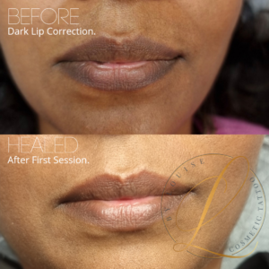 dark lip correction