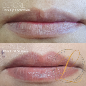 dark lip correction