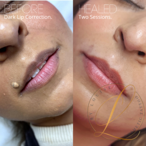 dark lip correction