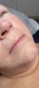 before Lip Blush Tattoo Melbourne