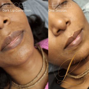 Dark lip correction