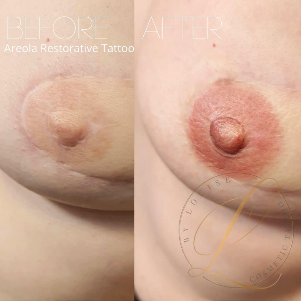 Side-by-side comparison of a breast before and after a restorative areola cosmetic tattoo.