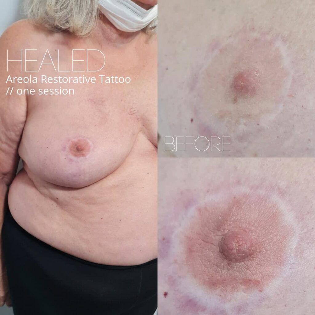 A side-by-side comparison of an areola before and after a restorative tattoo, showing improved definition and color in one session.