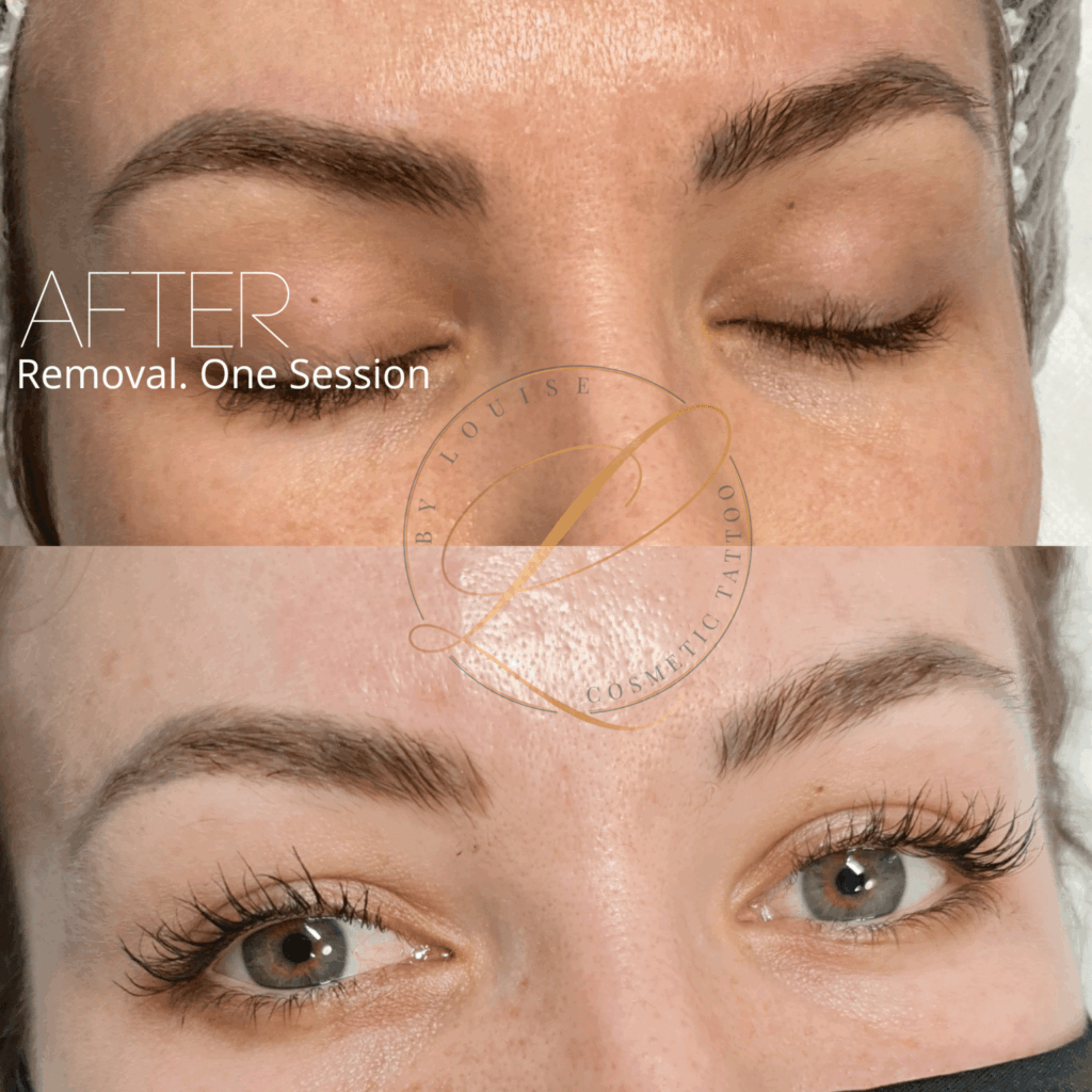 Close-up of a person's face showing the results of eyebrow cosmetic tattoo removal after one session, with eyes closed in the upper panel and open in the lower panel.
