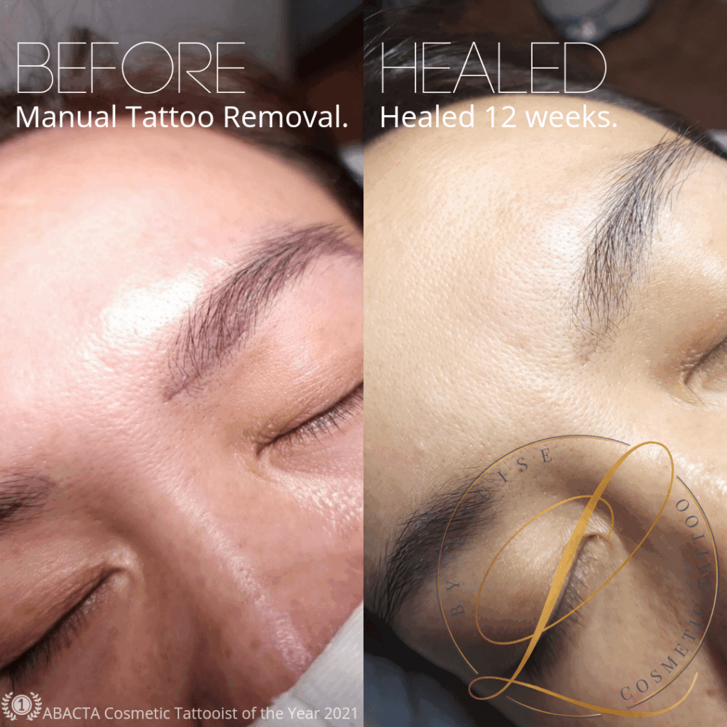 A before and after image showing manual eyebrow tattoo removal, with the treated area healed 12 weeks later.