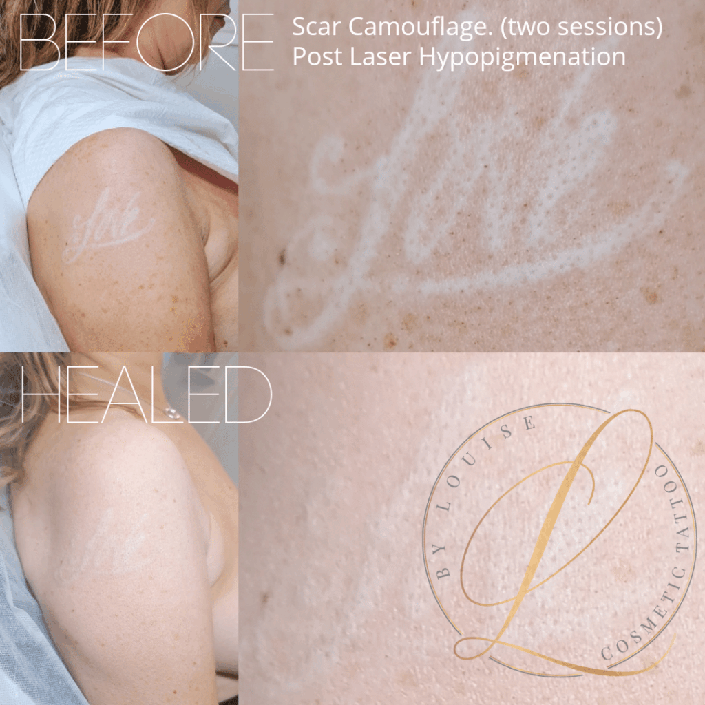 Before and after comparison of scar camouflage on an arm, showing successful treatment of post-laser hypopigmentation.