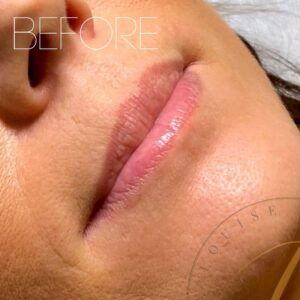 A close-up view of a person's lips and lower nose area, showing the natural lip shape and skin texture before a cosmetic procedure, with 'BEFORE' text visible.
