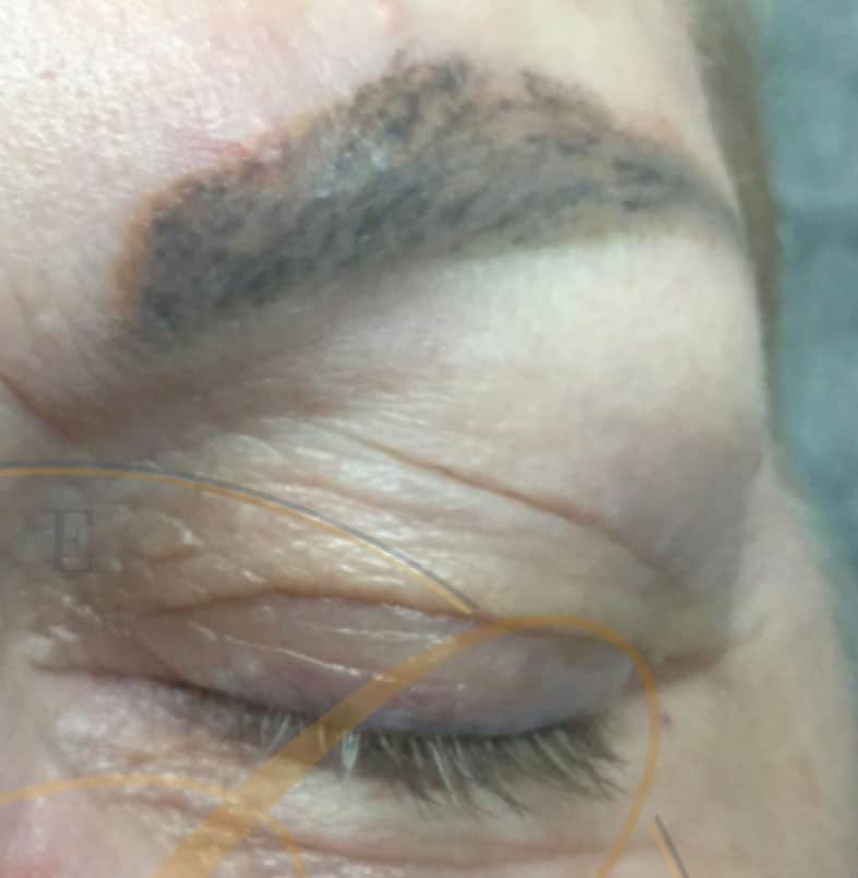 Close-up of a closed eye with a microbladed eyebrow and fine threads across the eyelid, possibly indicating a cosmetic procedure.