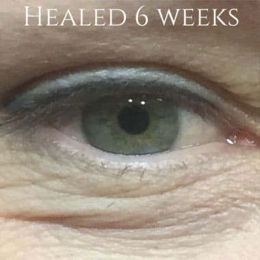 A close-up of a green eye with dark permanent eyeliner on the upper lid, showing the healed result six weeks post-procedure.