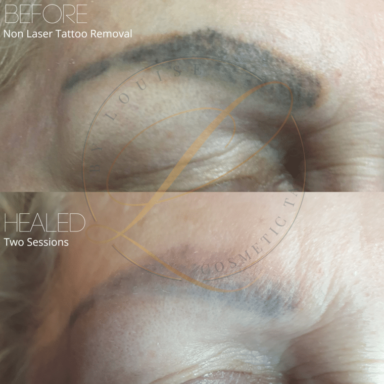 Before and after close-up of an eyebrow showing a dark cosmetic tattoo before removal and a significantly faded tattoo after two non-laser sessions.