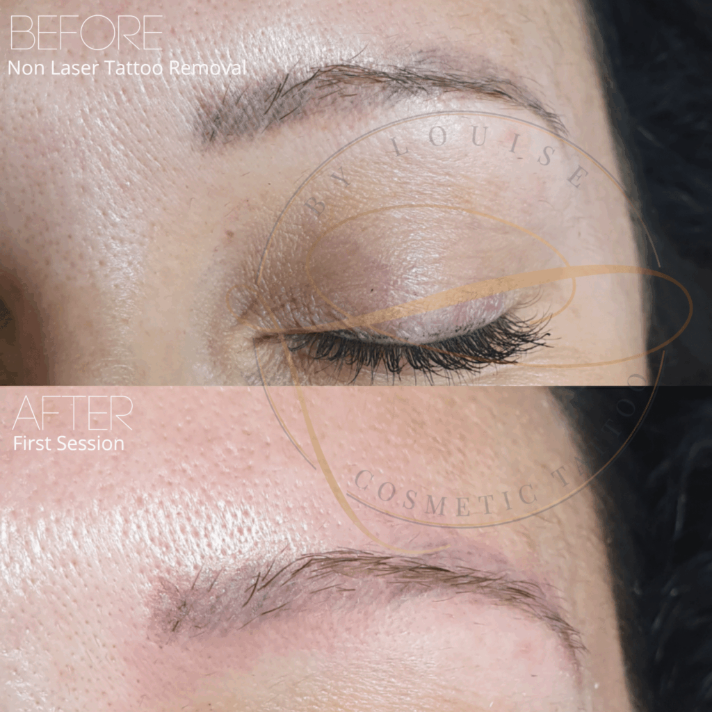 Close-up comparison showing an eyebrow before and after a non-laser tattoo removal, with the tattoo significantly lighter after the first session.