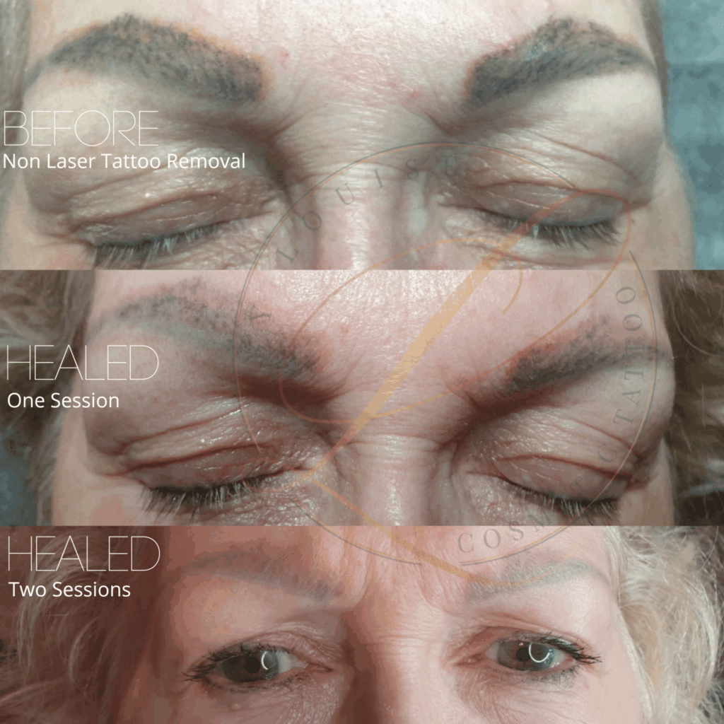 A three-panel image showing the progress of non-laser eyebrow tattoo removal: before, healed after one session, and healed after two sessions.