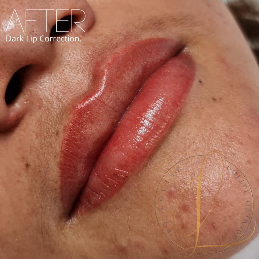 Close-up of a person's lips after dark lip correction, showing a vibrant reddish-pink color.