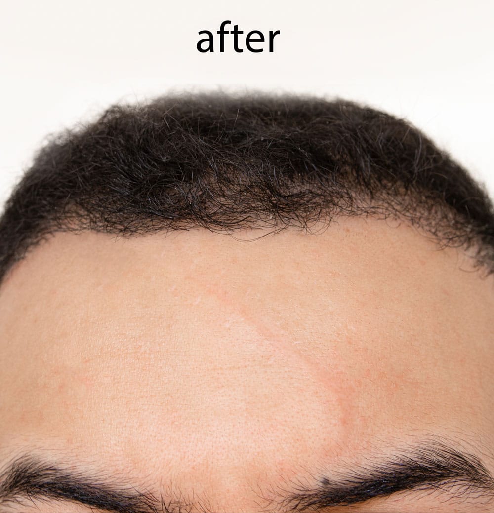 Close-up 'after' image showing a person's forehead and hairline with dark, textured hair, and a faint scar on the forehead.
