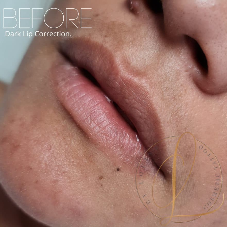 Close-up of a person's mouth and lower nose, showing lips before a dark lip correction procedure, with 'BEFORE' text overlay.