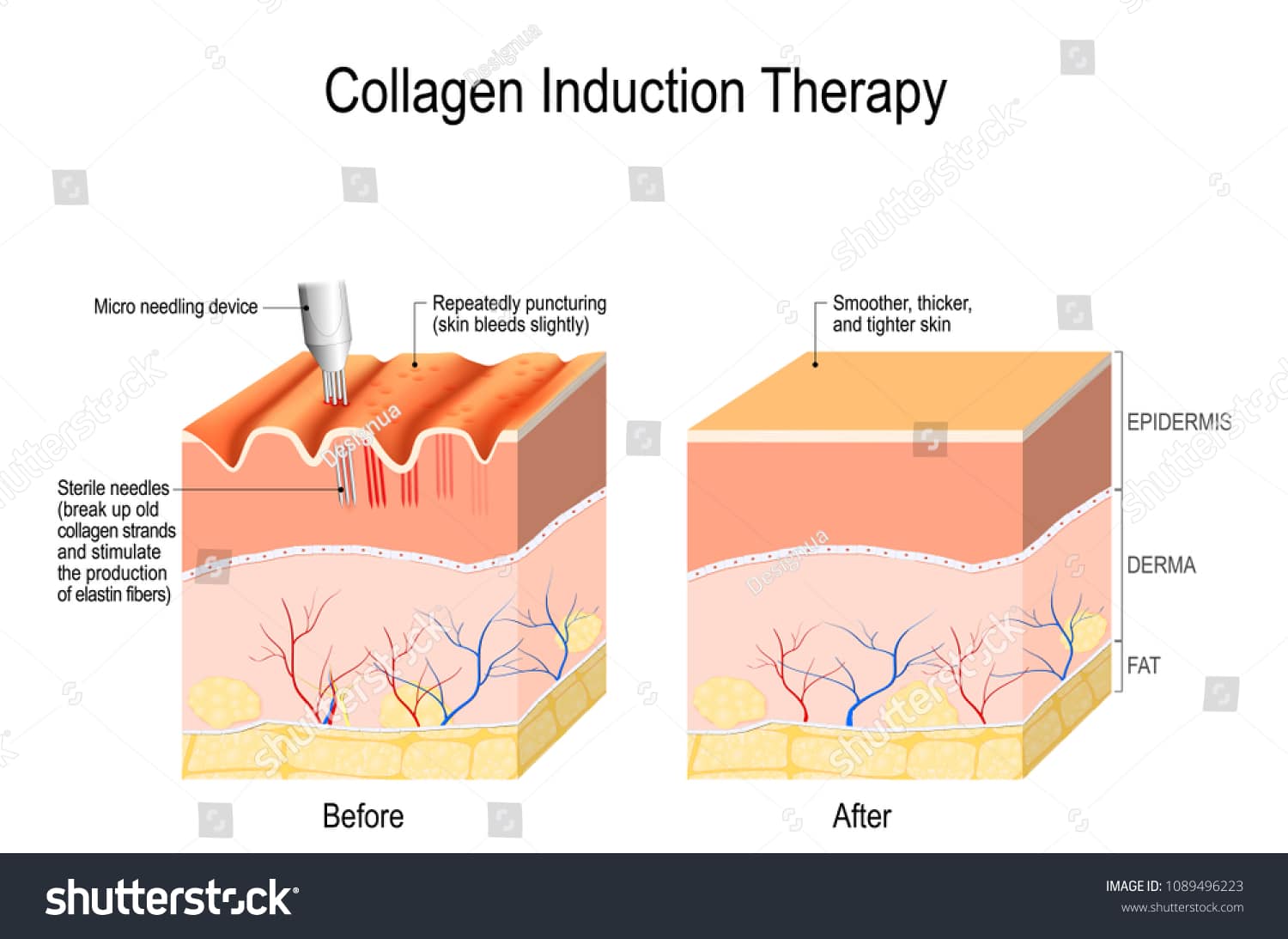 Diagram illustrating collagen induction therapy with 'Before' showing micro needling puncturing skin and 'After' showing smoother, thicker, tighter skin.