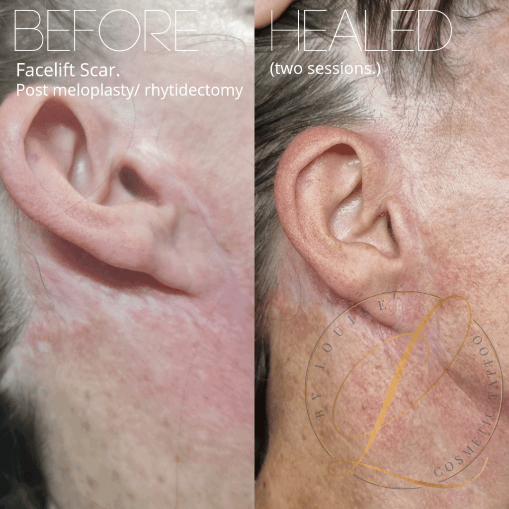 Before and after comparison of a facelift scar on a person's jawline, showing significant improvement after cosmetic tattooing.