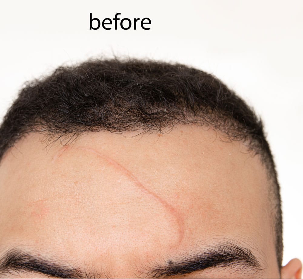 Close-up of a person's forehead showing a curved scar before treatment, with the text 'before' at the top.