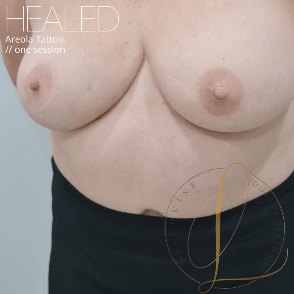 Healed 3D areola restorative tattoo results on a female chest after one session.
