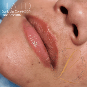 Close-up of healed lips after dark lip correction, showing a glossy, reddish-pink color and the surrounding skin.