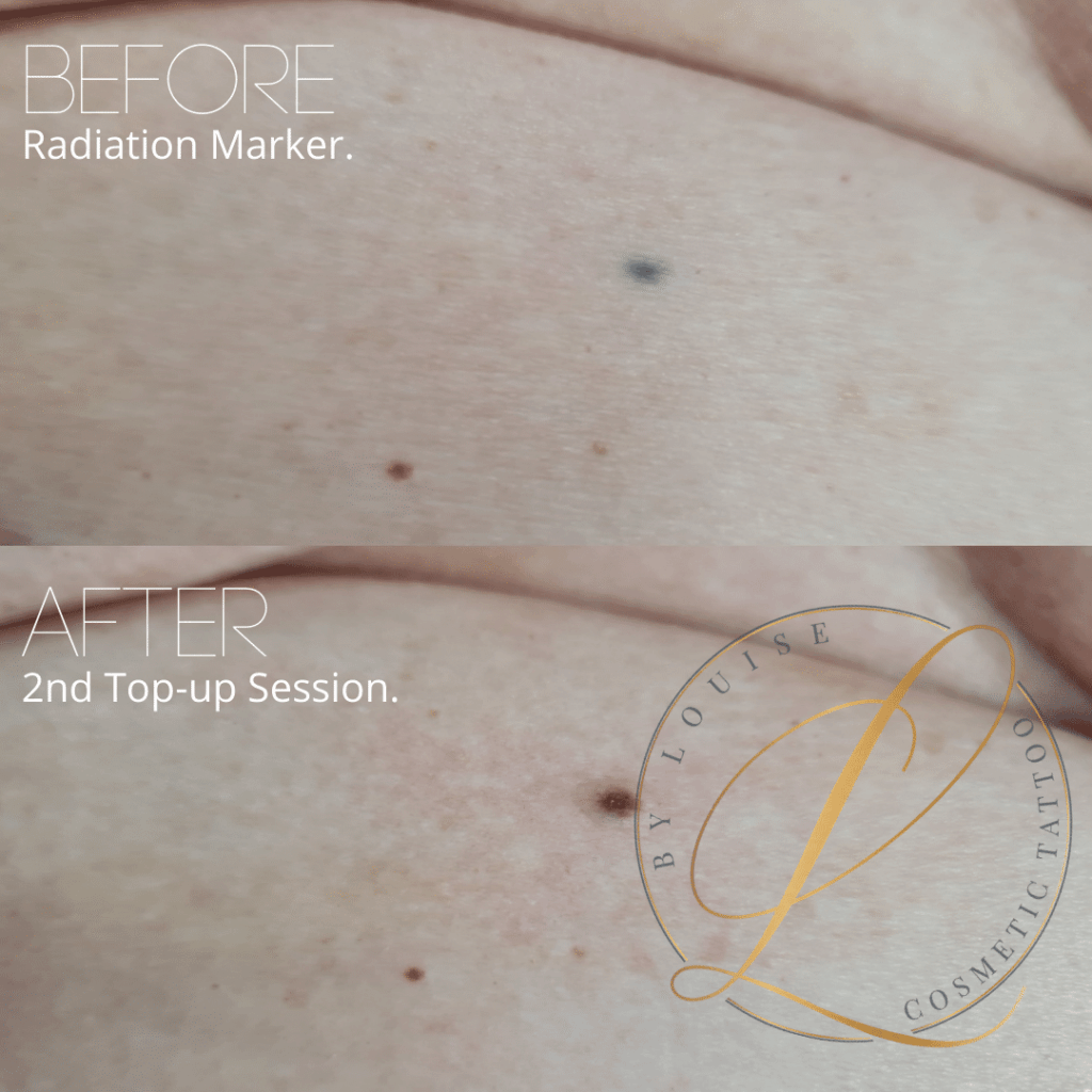 Before and after comparison showing a dark radiation marker on skin, which is then covered and blended with a cosmetic tattoo after a second top-up session.