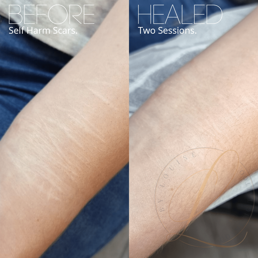 A before and after image of an arm showing significant reduction of self-harm scars after two healing sessions.