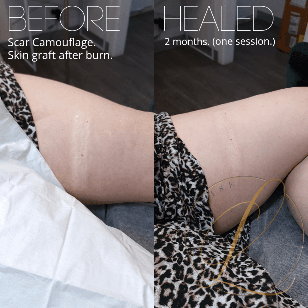 Before and after split image of a skin graft on a hip, showing significant scar camouflage improvement 2 months post one session.