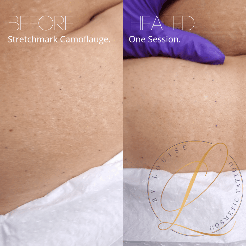 Before and after comparison of skin with stretch marks, showing significant improvement after one session of stretch mark camouflage.
