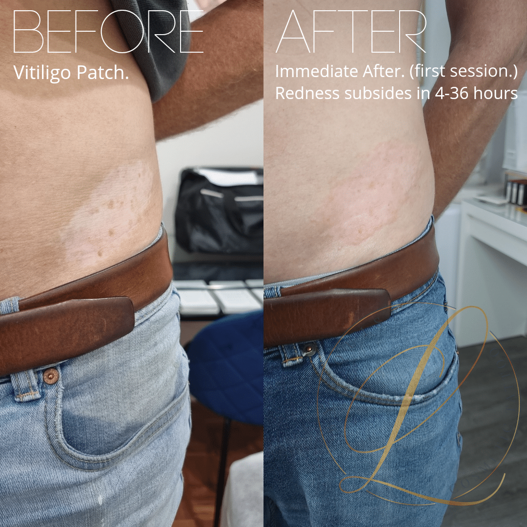Before and after comparison of a vitiligo patch on a person's abdomen, showing the white patch before treatment and immediate redness after the first session.